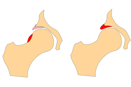 From Trends to Transformation: The Evolving Role of Arthroscopy in Treating Hip Impingement