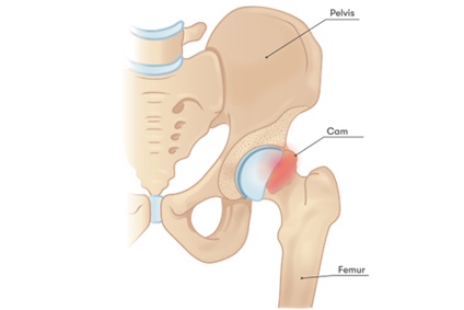 Long-Term Outcomes of Hip Arthroscopy for Femoroacetabular Impingement Syndrome: A Decade of Data