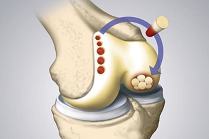 Osteochondral Transplantation: Can It Restore Hip Function and Improve Outcomes?