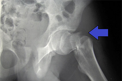 Radiological Insights in Hip Arthroscopy: Key Predictors of Successful Outcomes for FAI Patients