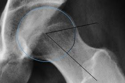 The Alpha Angle's Predictive Power: Understanding Chondral Damage Risks in Cam-Type FAI