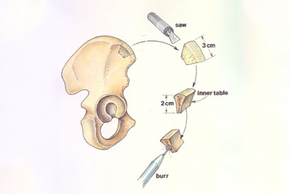 The Limits of Stability: Understanding Posterior Glenoid Bone Grafting in Shoulder Instability