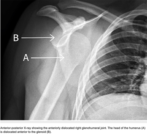 Artificial Intelligence Can Define and Predict the Optimal Observed Outcome After Anterior Shoulder Instability Surgery: An Analysis of 200 Patients With 11-Year Mean Follow-Up