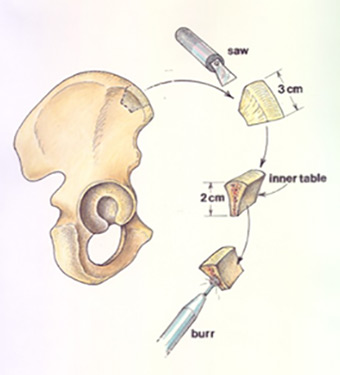 The Limits of Stability: Understanding Posterior Glenoid Bone Grafting in Shoulder Instability