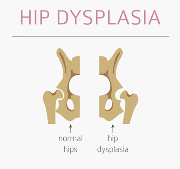 Hip Dysplasia No Barrier to Long-Term Success After Hip Arthroscopy