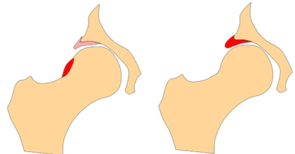 From Trends to Transformation: The Evolving Role of Arthroscopy in Treating Hip Impingement