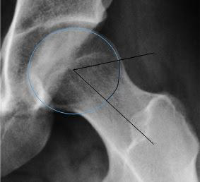 The Alpha Angle's Predictive Power: Understanding Chondral Damage Risks in Cam-Type FAI